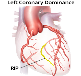 Left coronary dominant heart