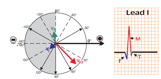 Heart axis determination in positive hemisphere of I limb lead