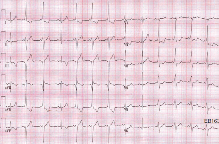 ECG left axis deviation and WPW syndrome type B