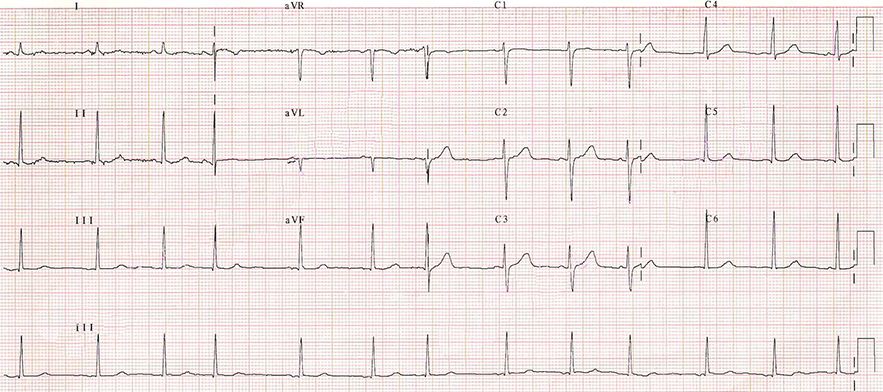 Irregular ECG with no P wave, and calibration 10mm