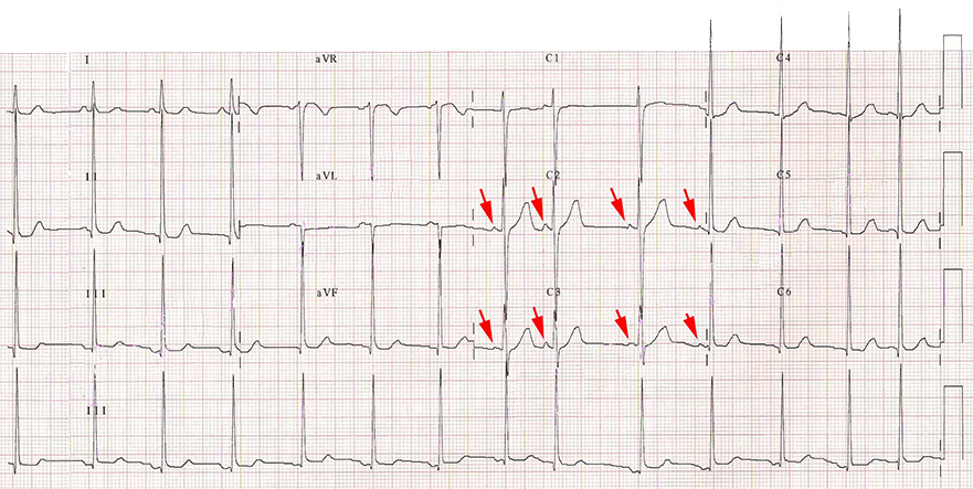 Calibration 20mm ruling out diagnosis atrial fibrillation