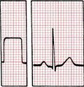 ECG calibration 1mV = 10mm