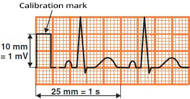 ECG standard calibration 10mm x 5mm, 10mm = 1mV