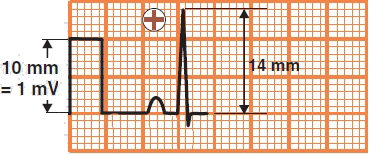 Calibration 10mm and 14mm ECG deflection