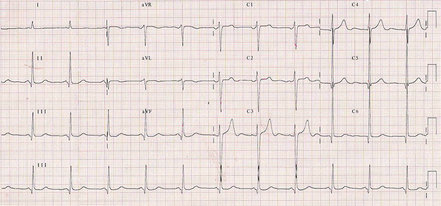 ECG left ventricular hypertrophy with standard calibration 10mm