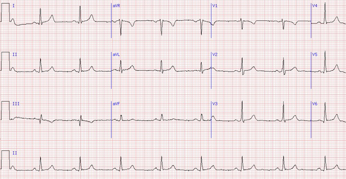 ECG sinus rhythm with standard calibration 10mm/mV