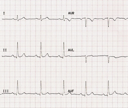 ECG paper with correct position of limb electrodes