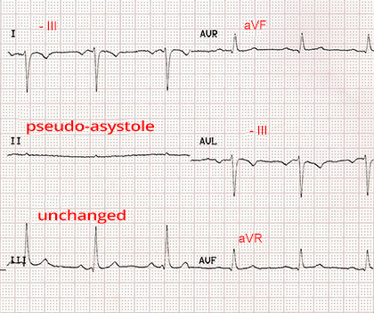 ECG paper with reversal RA RL (right arm, right leg) limb electrodes, pseudo-asystole II