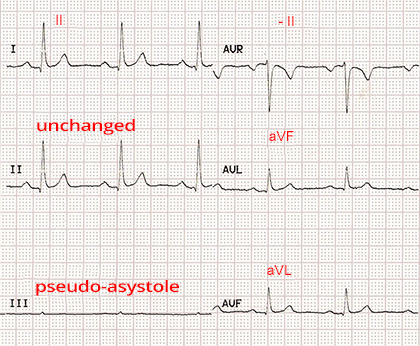 ECG paper with reversal LA RL (left arm, right leg) limb electrodes, pseudo-asystole III