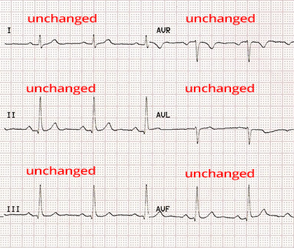 Unchanged ECG paper after reversal of LL and RL electrodes