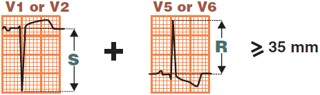 ECG left ventricular hypertrophy, Sokolov Lyon voltage criteria (S wave depth in V1 + tallest R wave height in V5-V6 more than 35 mm)