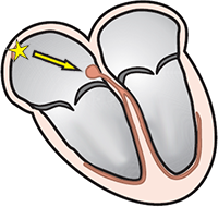 narrow supraventricular QRS complex