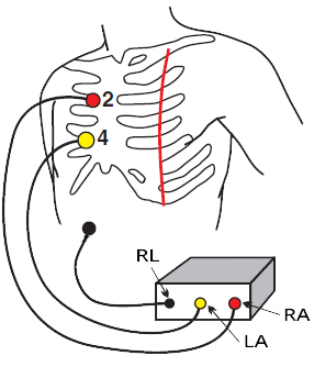ECG Lewis lead
