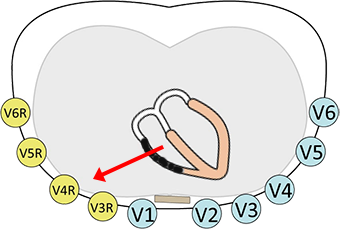 ECG (V3R-V6R) right-sided leads, isolated RVMI, culprit vessel, ischemic electrical vector