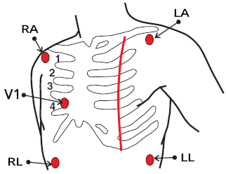 ECG 5 electrode system