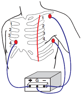 Modified Chest Lead, Marriotts Chest Lead, Modified Central Lead (MCL1)
