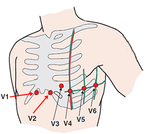 ECG leads V1, V2, in 6th intercostal space, left anterior hemiblock, anterior infarction