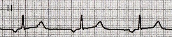 ECG ectopic inverted retrograde P wave, with ectopic atrial rhythm