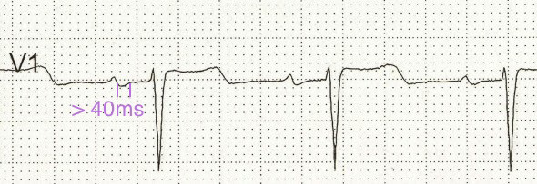 ECG P Mitrale and left atrial dilatation in lead V1 (biphasic P wave)