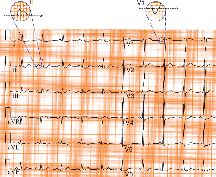 ECG p mitrale in lead II (bifid P wave) and lead V1 (biphasic P wave)