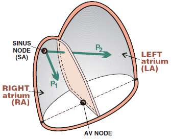 Left atrial hypertrophy electrical vector and P mitrale
