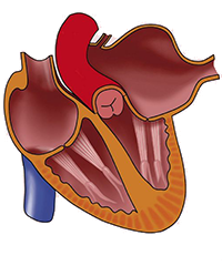 Left atrial pressure overload and left atrial hypertrophy