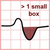 ECG P Mitrale terminal negative portion