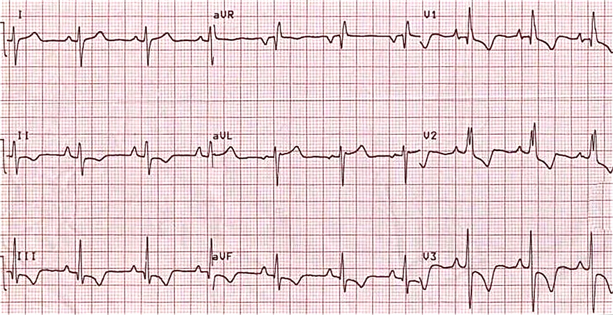ECG cor pulmonale, P pulmonale, right ventricular hypertrophy, righ axis deviation, righ bundle branch block