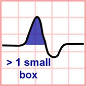 ECG P Pulmonale (biphasic) in lead V1