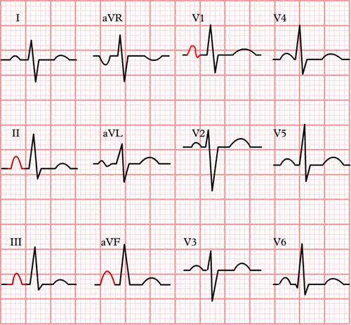 ECG criteria right atrial enlargement (P pulmonale), peaked P waves in lead II 