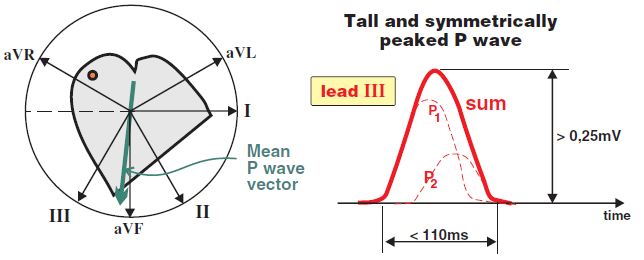 P pulmonale (tall and symmetrically peaked P wave) in frontal plane ECG II lead