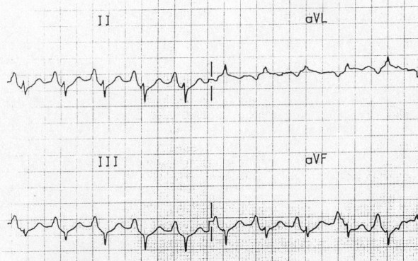 ECG p pulmonale (dextrocardiale)