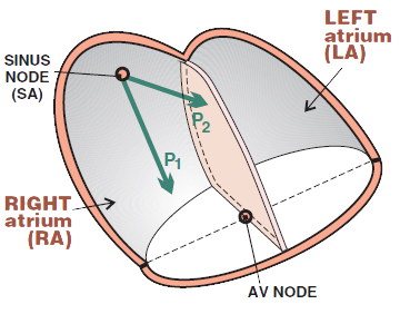 Right atrial hypertrophy (P pulmonale) electrical vector