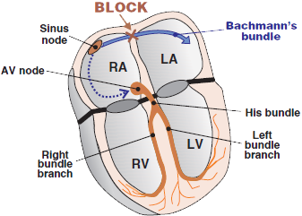 Heart interatrial conduction delay, Bachmann bundle block, interatrial block
