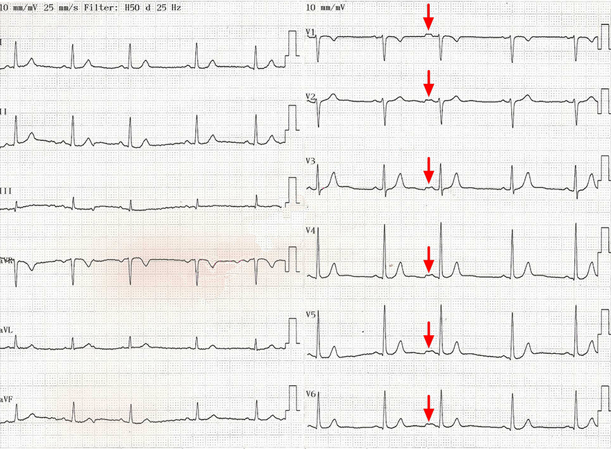 ECG with atrial premature complex and altering interatrial (Bachmann) block, type 2
