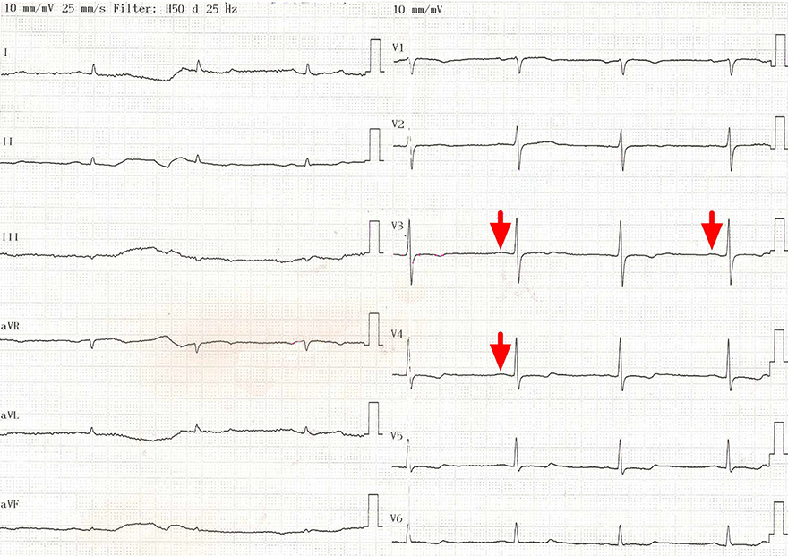 ECG sinus rhythm with standard Calibration and bachmann block
