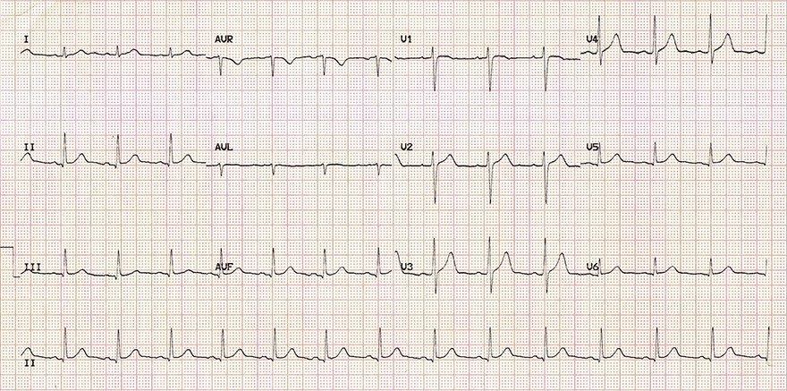 ECG normal small septal q wave with sinus rhythm