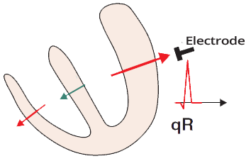 ECG normal Q wave origin with ventricular septum depolarization