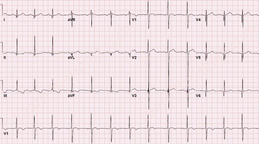 ECG dominant R wave V1 and hypertrophic cardiomyopathy