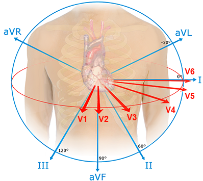 Dominant R wave in aVR and main electrical vector depolarization in ECG leads