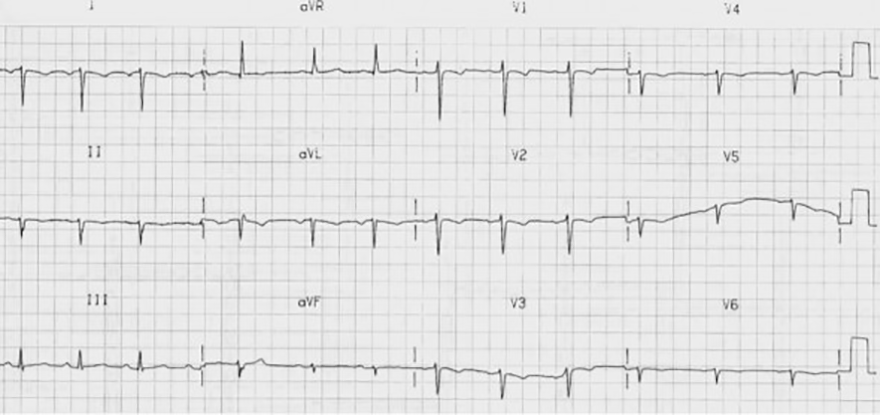 ECG dextrocardia with dominant r wave avr lead