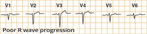 ECG poor R wave progression, R wave in V3 less than 4mm