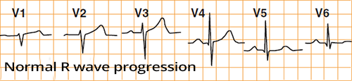 ECG R wave progression from V1 to V5
