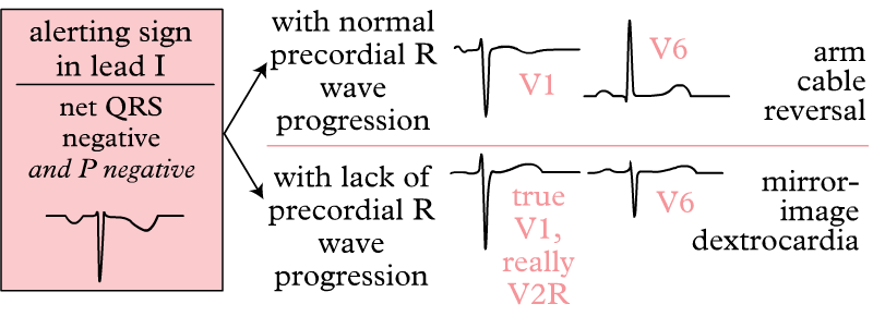 ECG differential diagnosis dextrocardia vs. reversal of the left and right arm electrodes