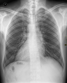 x-ray-dextrocardia-image