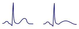 ECG T wave concordance
