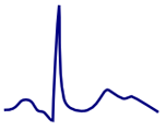 ECG double peak, camel hump T wave