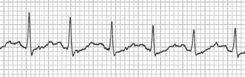ECG double camel hump T waves (T wave and P wave) and sinus tachycardia