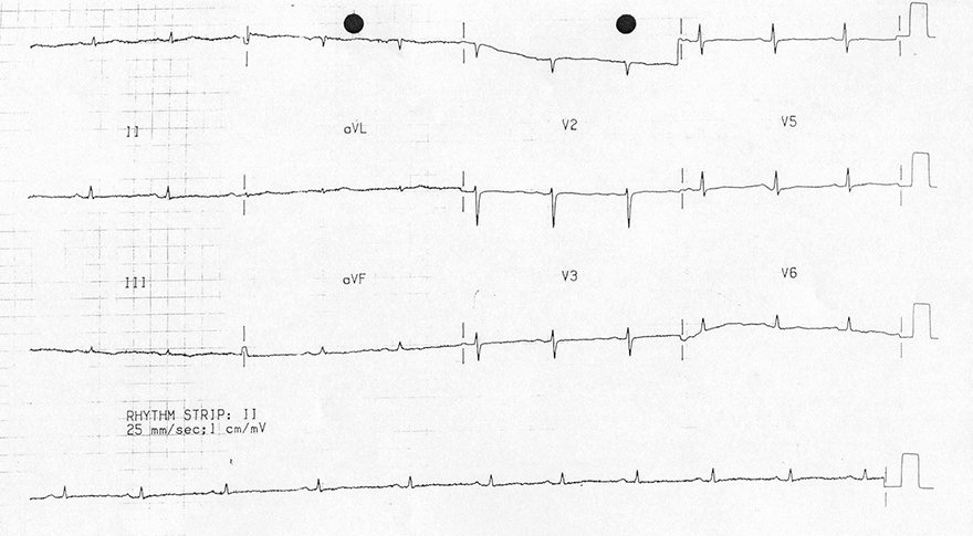 ECG flattened T waves hypothyroidism