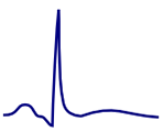 ECG flattened T waves
